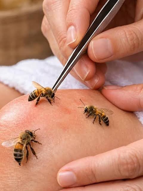Aplicación de apiterapia con abeja bajo valoración previa